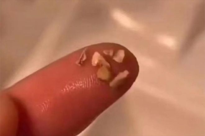不出门解决牙结石方法分享！这些生活小妙招要知道！(图3)