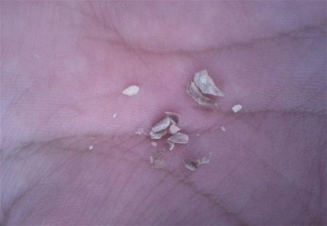 彩神牙结石不用洗牙！过来人分享生活小妙招！！(图5)